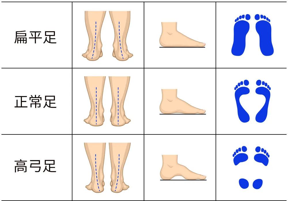 四個(gè)青少年就有一個(gè)是扁平足，扁平足應(yīng)該怎么矯正？